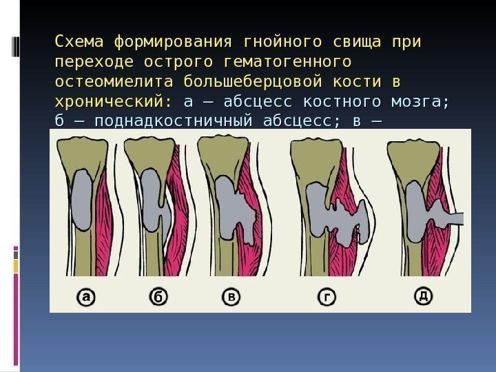 Схема формирования гнойного свища при переходе острого гематогенного остеомиелита большеберцовой кости в хронический: 