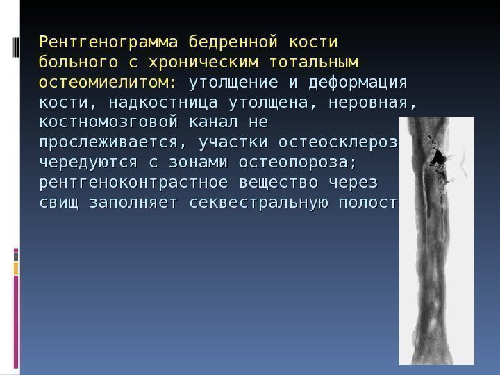 Рентгенограмма бедренной кости больного с хроническим тотальным остеомиелитом:  утолщение и деформация кости, надкостница