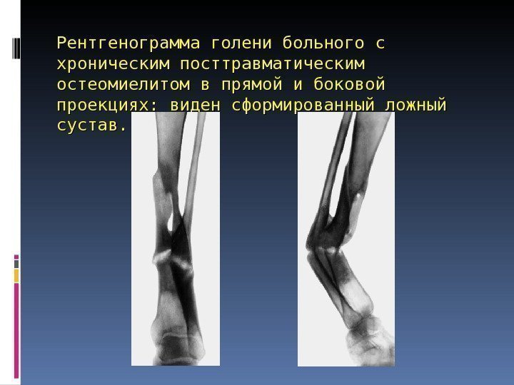Рентгенограмма голени больного с хроническим посттравматическим остеомиелитом в прямой и боковой проекциях: виден сформированный