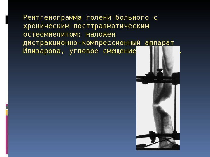 Рентгенограмма голени больного с хроническим посттравматическим остеомиелитом: наложен дистракционно-компрессионный аппарат Илизарова, угловое смещение устранено.