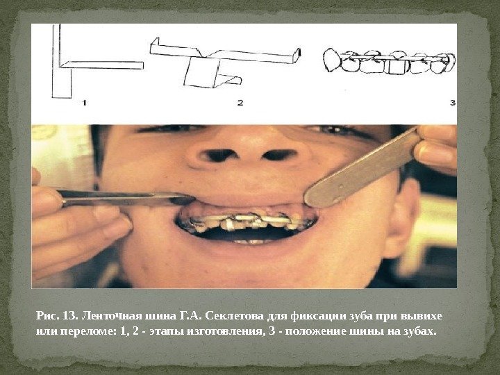 Рис. 13. Ленточная шина Г. А. Секлетова для фиксации зуба при вывихе или переломе: