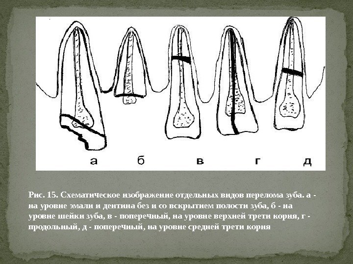 Рис. 15. Схематическое изображение отдельных видов перелома зуба. а - на уровне эмали и