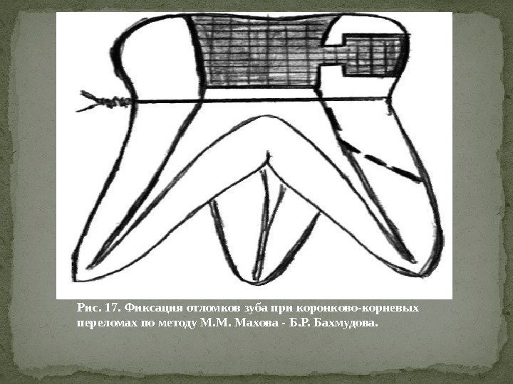 Рис. 17. Фиксация отломков зуба при коронково-корневых переломах по методу М. М. Махова -