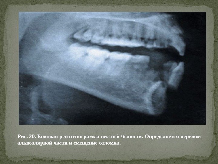 Рис. 20. Боковая рентгенограмма нижней челюсти. Определяется перелом альвеолярной части и смещение отломка. 