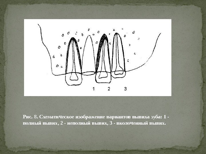 Рис. 8. Схематическое изображение вариантов вывиха зуба: 1 - полный вывих, 2 - неполный