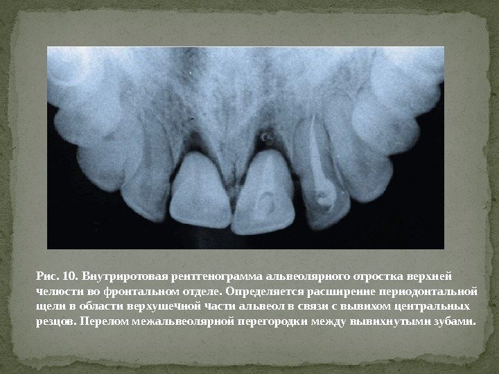 Рис. 10. Внутриротовая рентгенограмма альвеолярного отростка верхней челюсти во фронтальном отделе. Определяется расширение периодонтальной