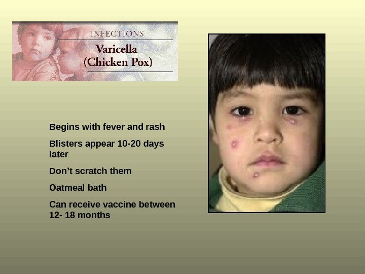 Begins with fever and rash Blisters appear 10 -20 days later Don’t scratch them