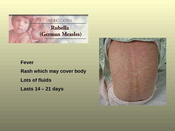 Fever Rash which may cover body Lots of fluids Lasts 14 – 21 days