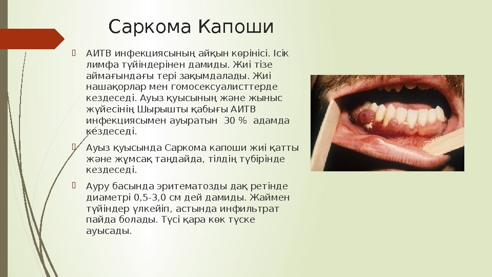 Саркома Капоши АИТВ инфекциясының айқын көрінісі. Ісік лимфа түйіндерінен дамиды. Жиі тізе аймағындағы тері