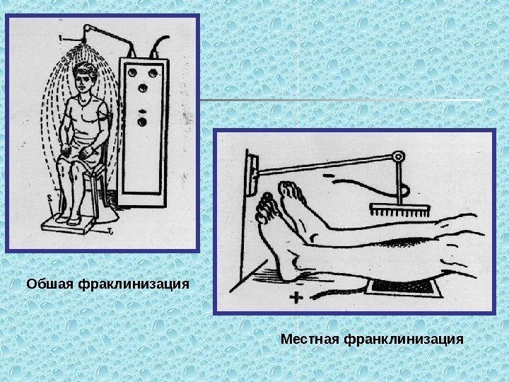   Обшая фраклинизация Местная франклинизация 