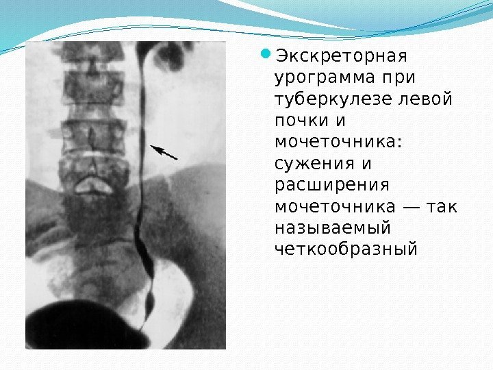  Экскреторная урограмма при туберкулезе левой почки и мочеточника:  сужения и расширения мочеточника