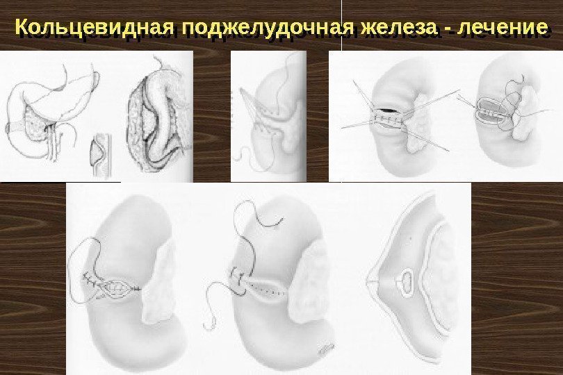 Кольцевидная поджелудочная железа - лечение 