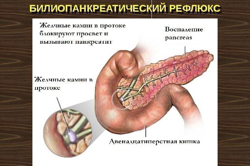 БИЛИОПАНКРЕАТИЧЕСКИЙ РЕФЛЮКС 