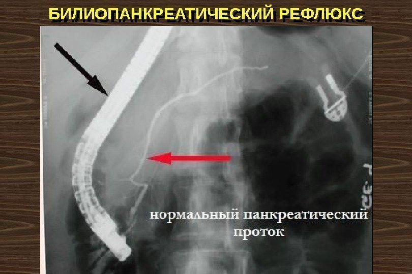 БИЛИОПАНКРЕАТИЧЕСКИЙ РЕФЛЮКС 