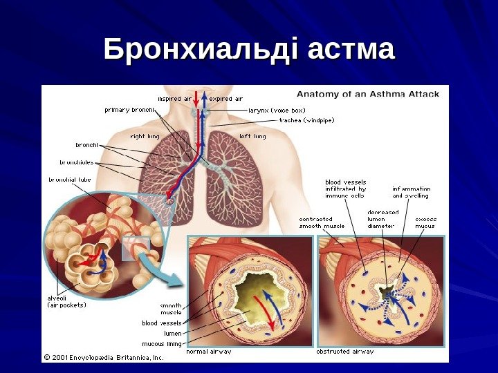 Бронхиальді астма 