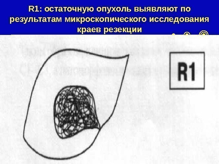 R 1: остаточную опухоль выявляют по результатам микроскопического исследования краев резекции 