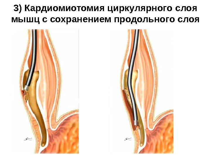 3) Кардиомиотомия циркулярного слоя мышц с сохранением продольного слоя 