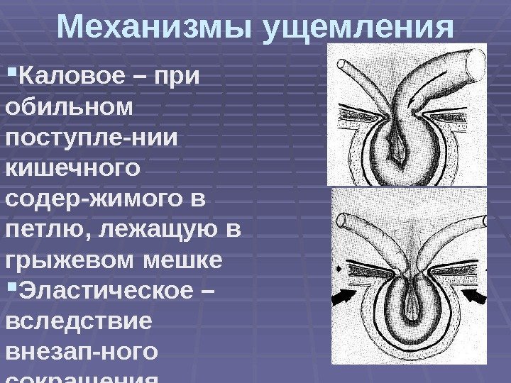 Презентация по грыжам живота