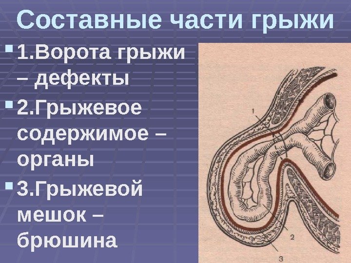 Составные части грыжи 1. Ворота грыжи – дефекты 2. Грыжевое содержимое – органы 3.