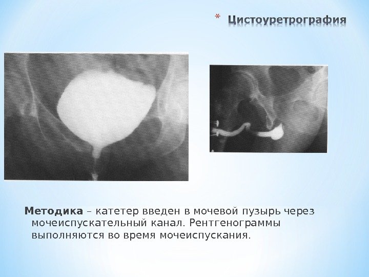 Методика – катетер введен в мочевой пузырь через мочеиспускательный канал. Рентгенограммы выполняются во время