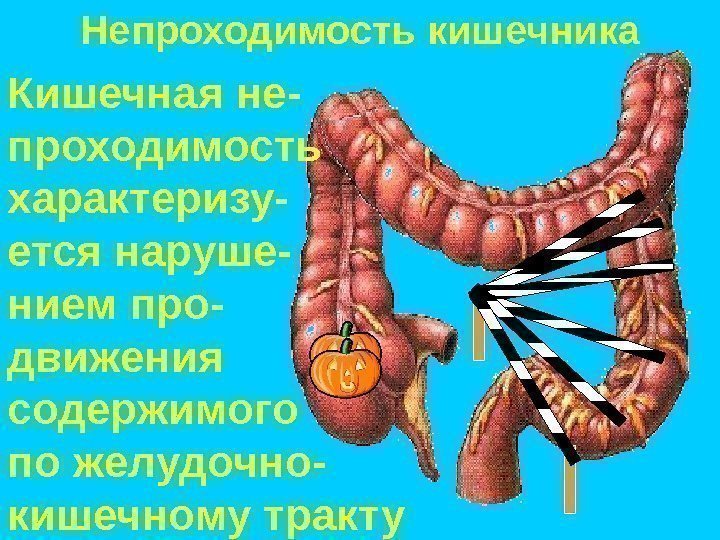 При непроходимости кишечника стул