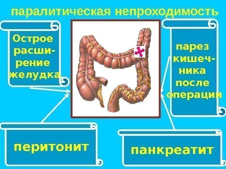 Парез кишечника презентация