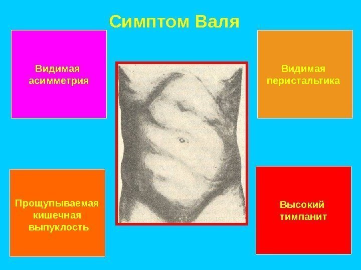 Кишечная непроходимость карта смп