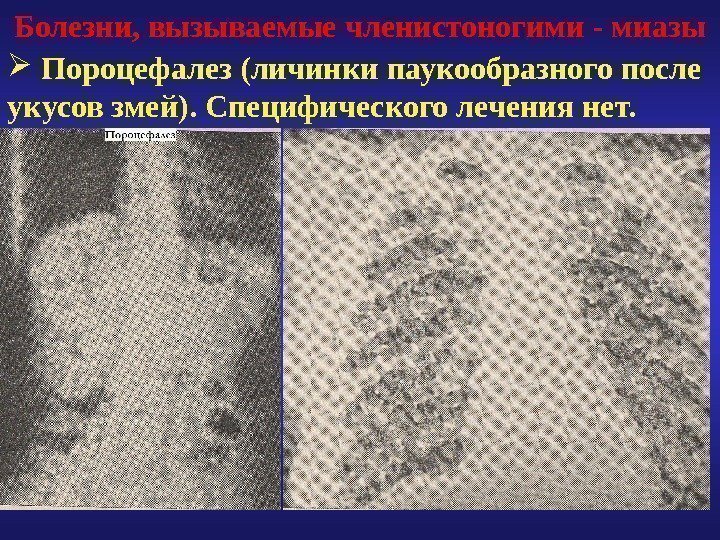 Болезни, вызываемые членистоногими - миазы  Пороцефалез (личинки паукообразного после укусов змей). Специфического лечения