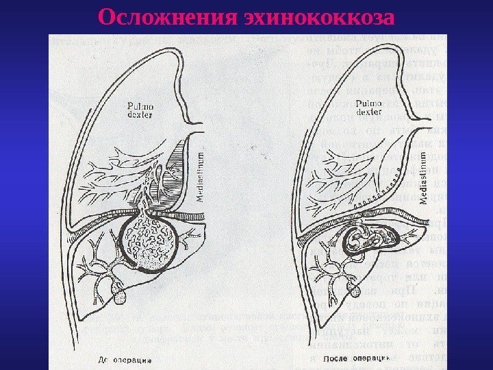 Осложнения эхинококкоза 