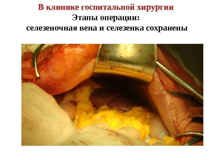 В клинике госпитальной хирургии Этапы операции:  селезеночная вена и селезенка сохранены 