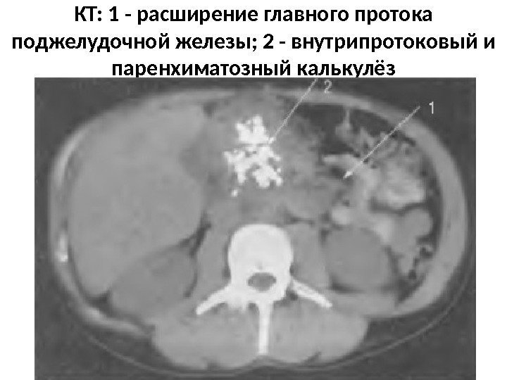 КТ: 1 - расширение главного протока поджелудочной железы; 2 - внутрипротоковый и паренхиматозный калькулёз