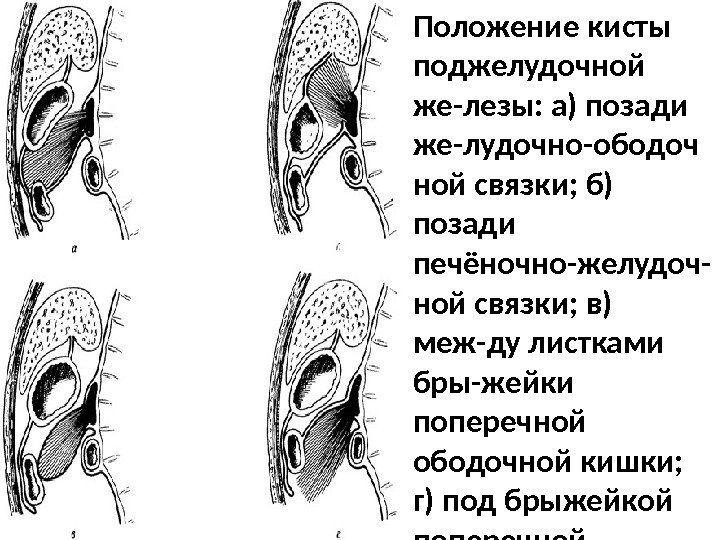 Положение кисты поджелудочной же-лезы: а) позади же-лудочно-ободоч ной связки; б) позади печёночно-желудоч- ной связки;