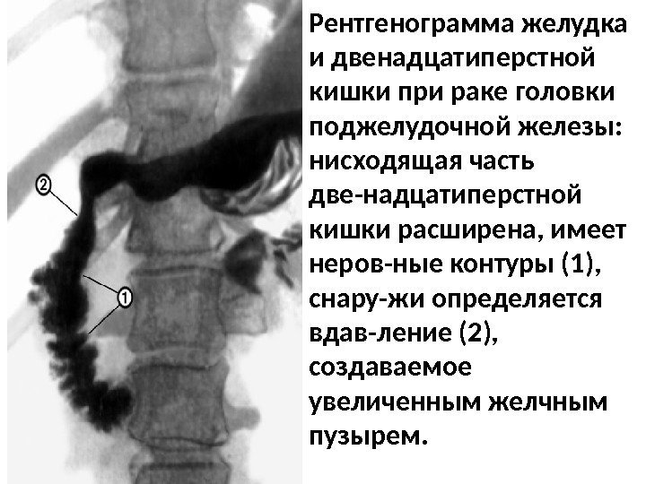 Рентгенограмма желудка и двенадцатиперстной кишки при раке головки поджелудочной железы:  нисходящая часть две-надцатиперстной