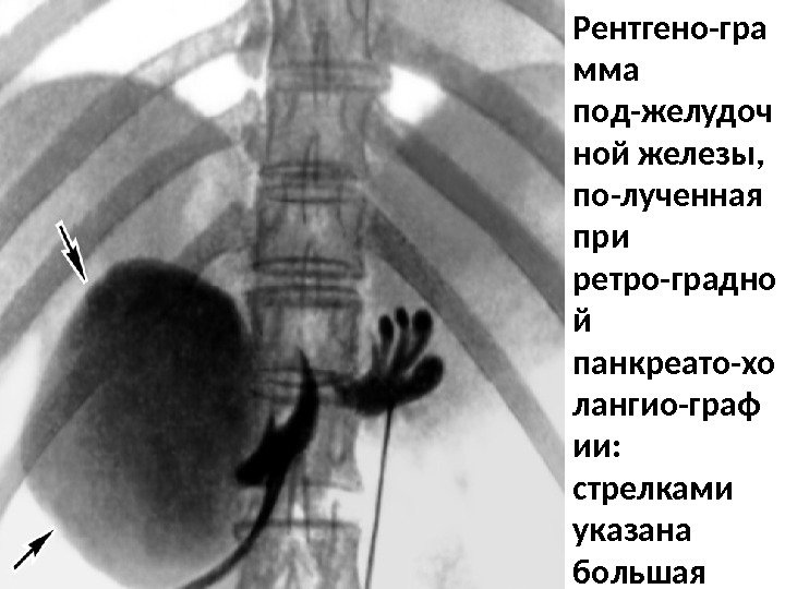 Рентгено-гра мма под-желудоч ной железы,  по-лученная при ретро-градно й панкреато-хо лангио-граф ии: 