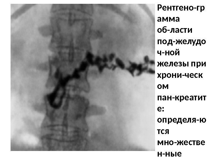Рентгено-гр амма об-ласти под-желудо ч-ной железы при хрони-ческ ом пан-креатит е:  определя-ю тся