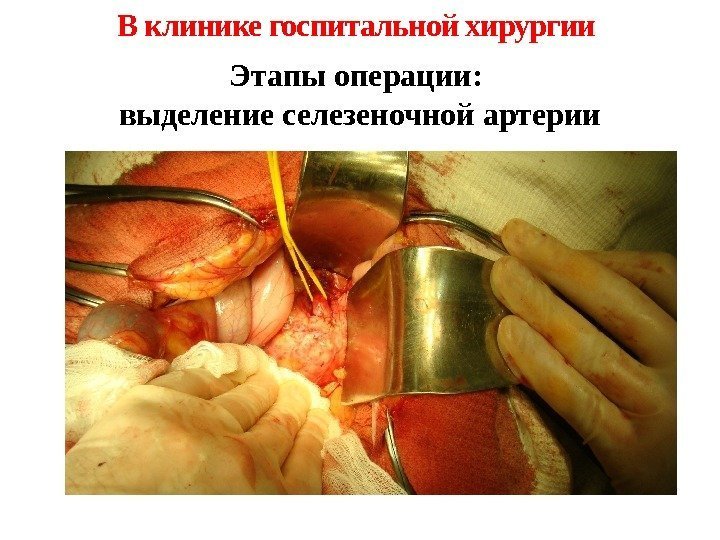Этапы операции:  выделение селезеночной артерии. В клинике госпитальной хирургии 