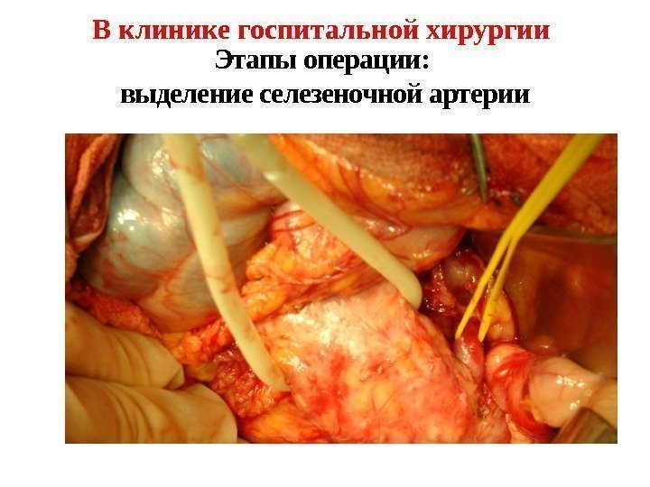 В клинике госпитальной хирургии Этапы операции:  выделение селезеночной артерии 