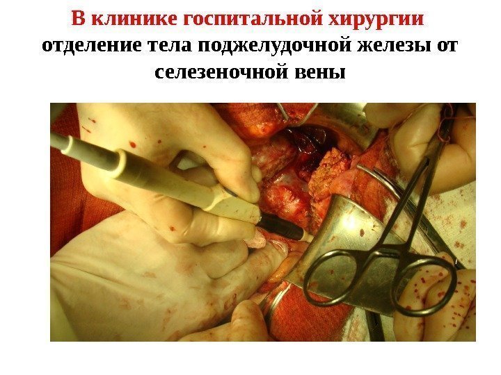 В клинике госпитальной хирургии отделение тела поджелудочной железы от селезеночной вены 