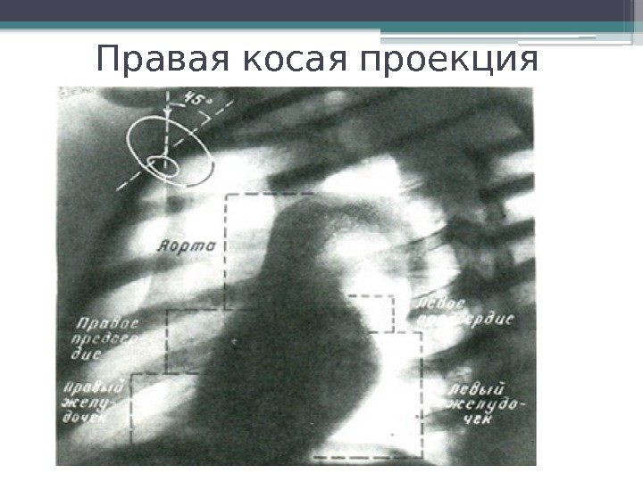 Косая проекция. Рентгенография сердца, правая косая проекция. Левая косая проекция рентген. Рентген ребер боковая проекция. Рентгенография грудной клетки правая косая проекция.