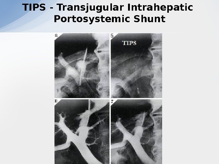 TIPS - Transjugular Intrahepatic Portosystemic Shunt 
