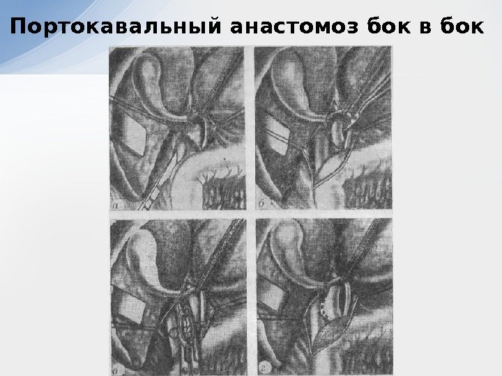 Портокавальный анастомоз бок в бок 