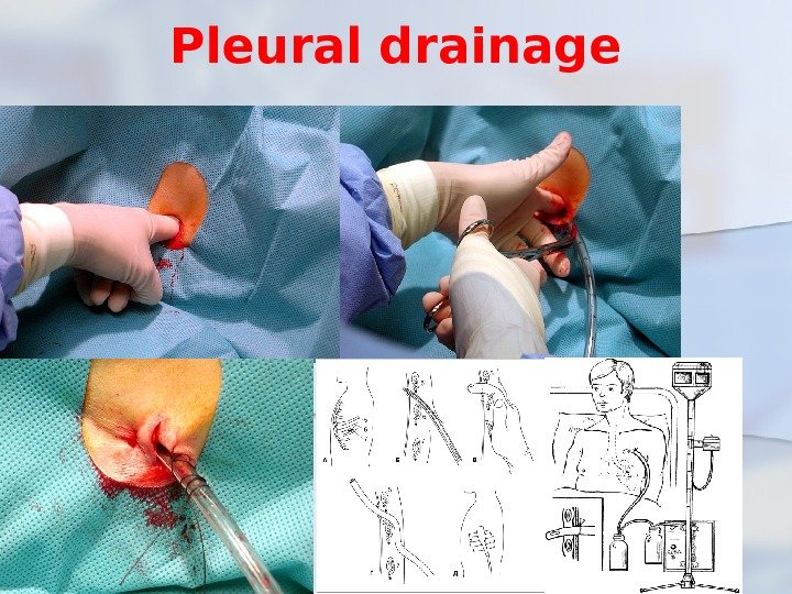 Pleural drainage 