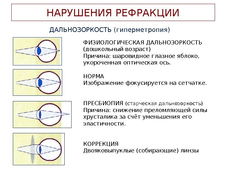 Что значит гиперметропия. Нарушения рефракции глаза близорукость дальнозоркость. Схема рефракции глаза. Нарушение рефракции глаза схема. Физиологическая причина дальнозоркости.