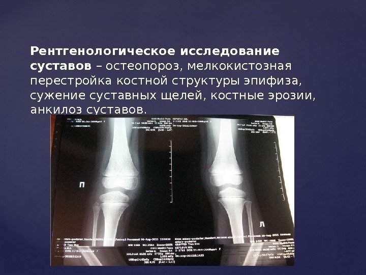Рентгенологическое исследование суставов – остеопороз, мелкокистозная перестройка костной структуры эпифиза,  сужение суставных щелей,
