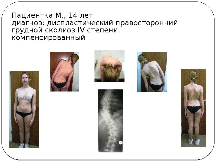 Пациентка М. , 14 лет диагноз: диспластический правосторонний грудной сколиоз IV степени,  компенсированный
