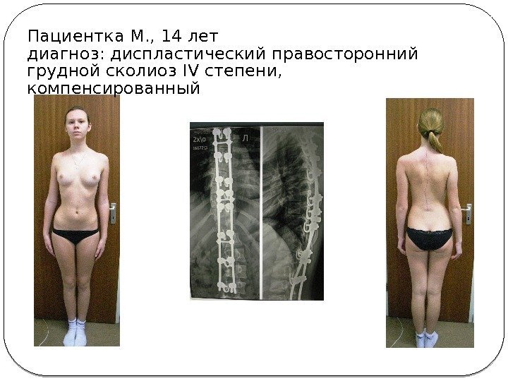 Пациентка М. , 14 лет диагноз: диспластический правосторонний грудной сколиоз IV степени,  компенсированный