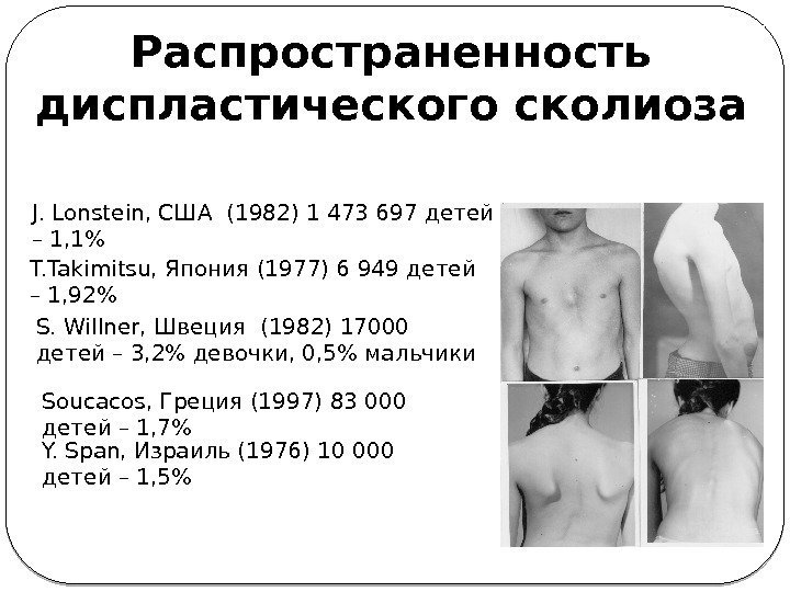 Распространенность диспластического сколиоза J. Lonstein, США (1982) 1 473 697 детей – 1, 1