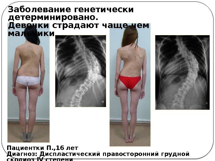 Пациентки П. , 16 лет Диагноз: Диспластический правосторонний грудной сколиоз IV степени Заболевание генетически
