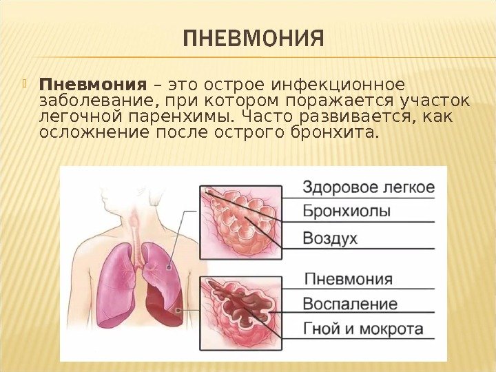  Пневмония – это острое инфекционное заболевание, при котором поражается участок легочной паренхимы. Часто