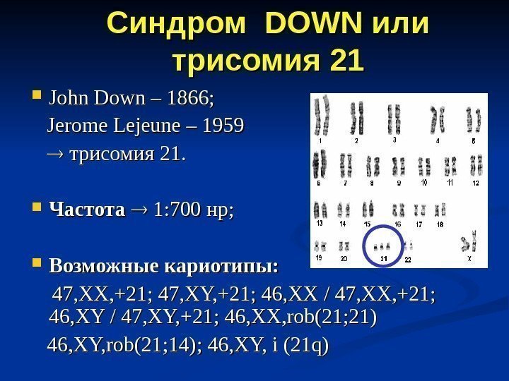 Синдром  DOWN илиили  трисомия 21 21 John Down – 1866;  